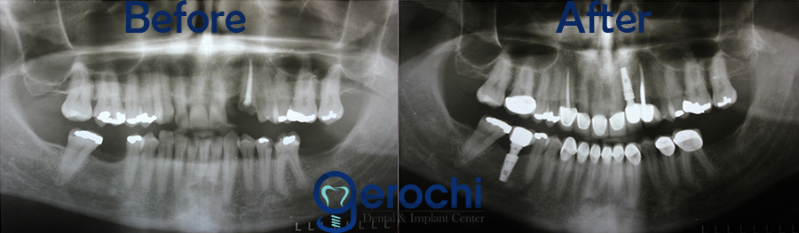 Before and After Implant Xray
