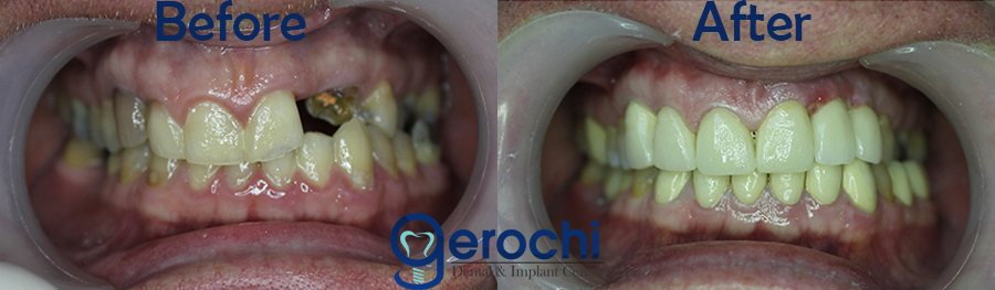 Before and After Single Implant